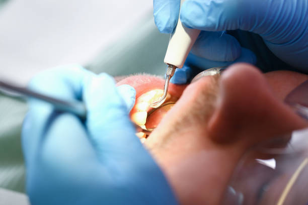 Best Emergency Wisdom Teeth Removal in Clksville, AR